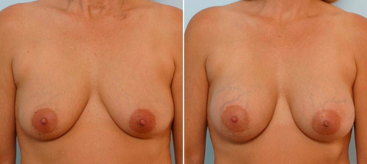 Breast Augmentation Before & After Photo - Patient 54886660 - Image 1