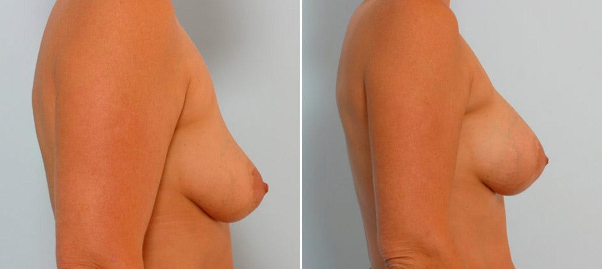 Breast Augmentation Before & After Gallery - Patient 54886660 - Image 3