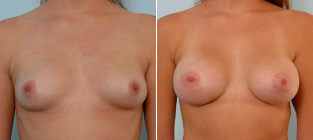 Breast Augmentation Before & After Gallery - Patient 54886661 - Image 1