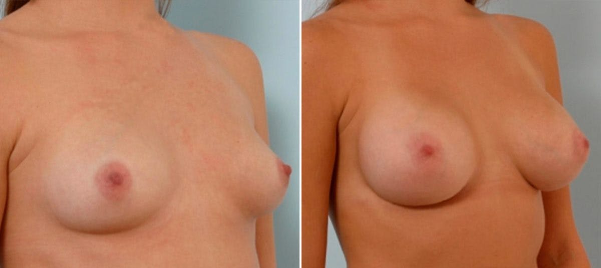 Breast Augmentation Before & After Gallery - Patient 54886661 - Image 2