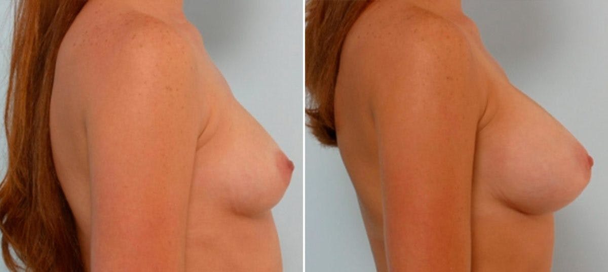 Breast Augmentation Before & After Gallery - Patient 54886661 - Image 3