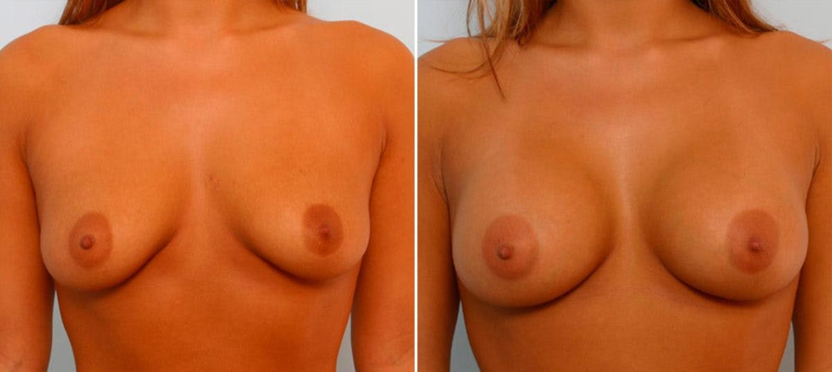 Breast Augmentation Before & After Gallery - Patient 54886667 - Image 1
