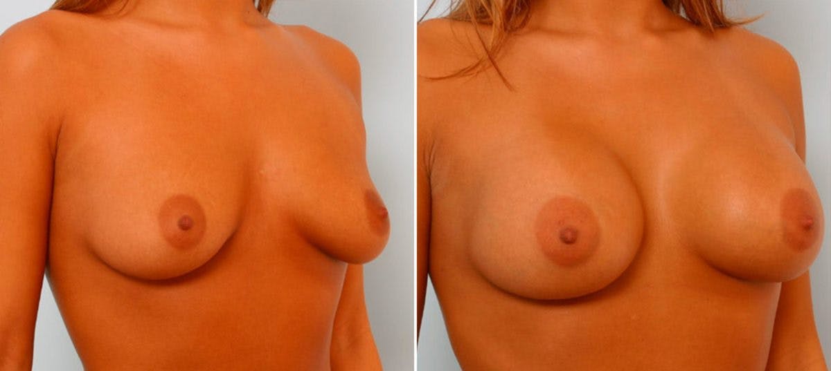Breast Augmentation Before & After Gallery - Patient 54886667 - Image 2