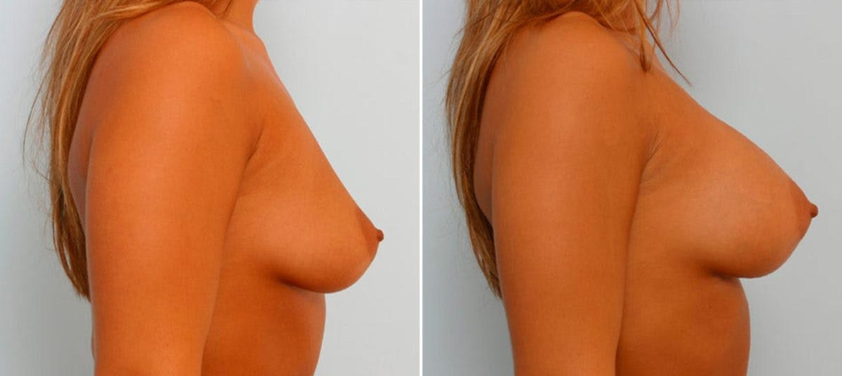 Breast Augmentation Before & After Gallery - Patient 54886667 - Image 3