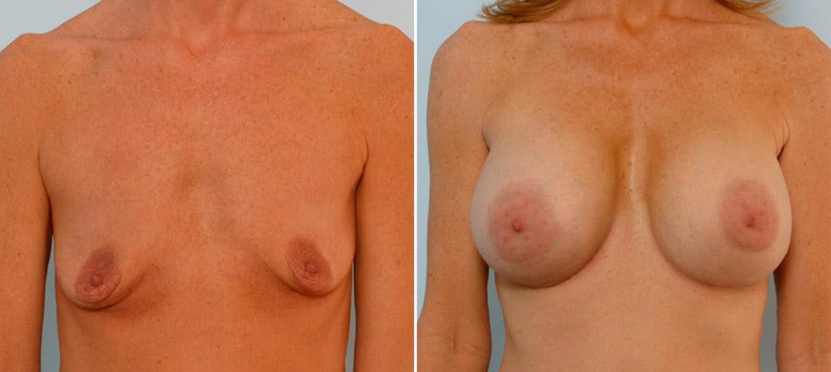 Breast Augmentation Before & After Gallery - Patient 54886670 - Image 1