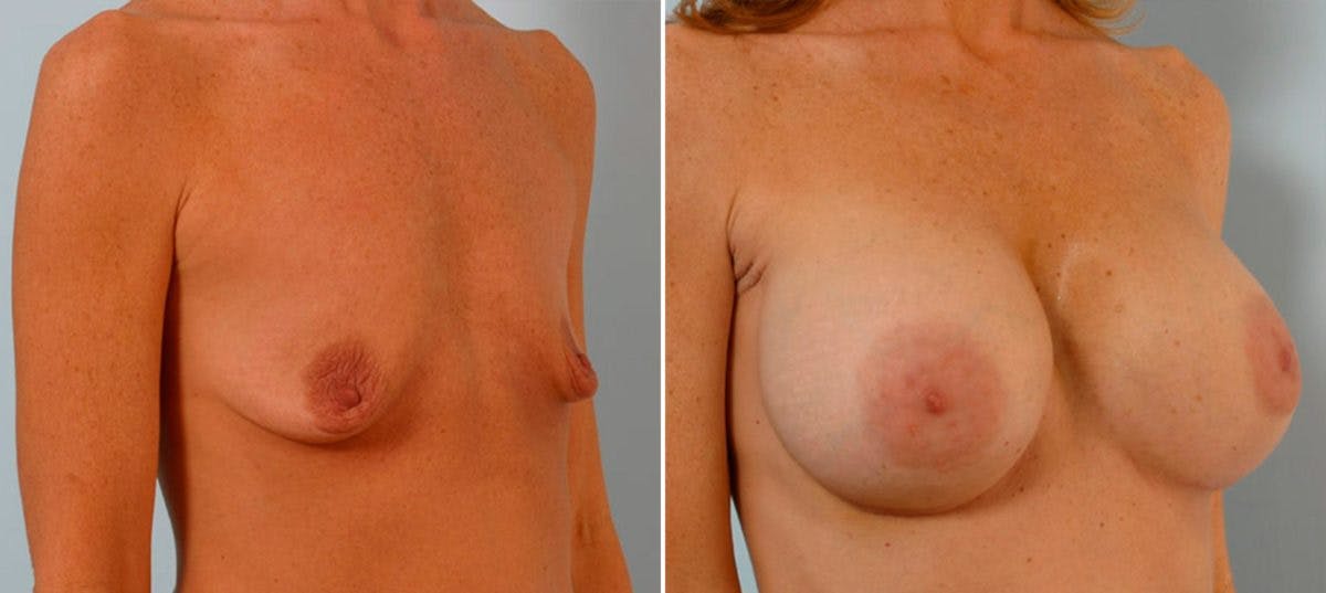 Breast Augmentation Before & After Gallery - Patient 54886670 - Image 2
