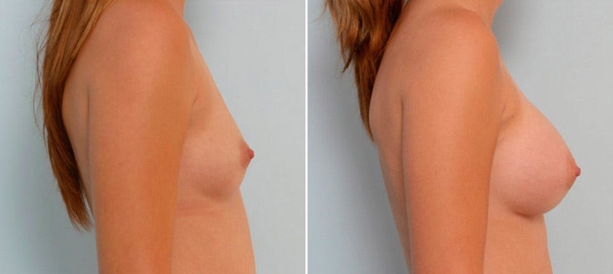Breast Augmentation Before & After Gallery - Patient 54886671 - Image 3