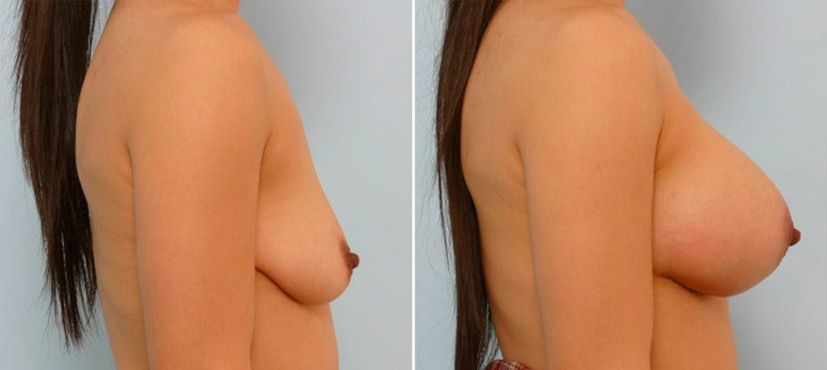 Breast Augmentation Before & After Gallery - Patient 54886678 - Image 3