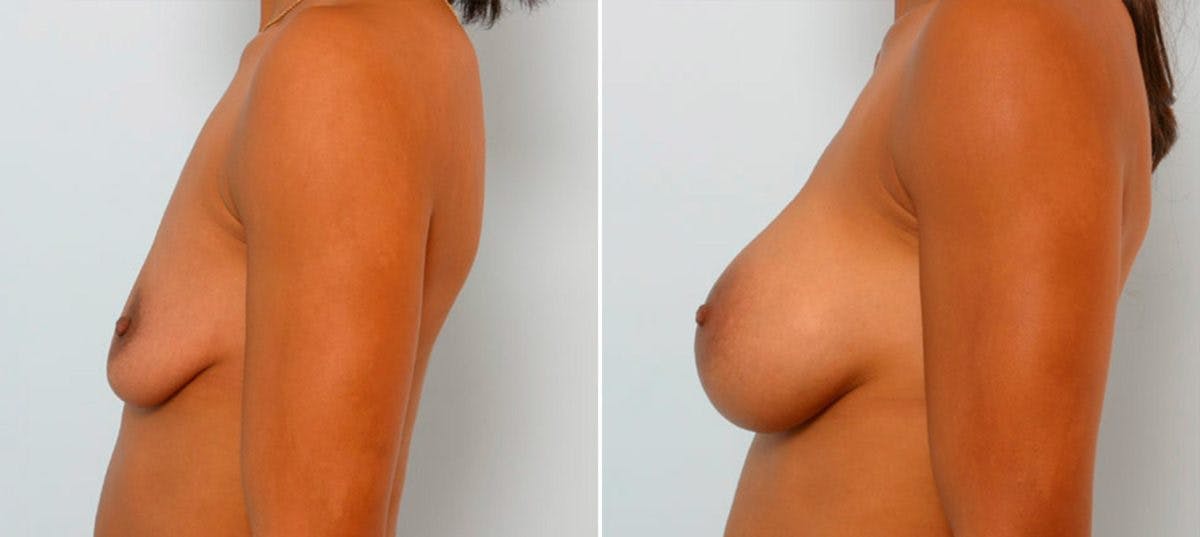 Breast Augmentation Before & After Gallery - Patient 54886695 - Image 3
