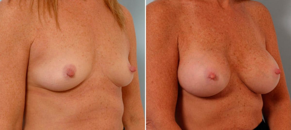 Breast Augmentation Before & After Gallery - Patient 54886706 - Image 2