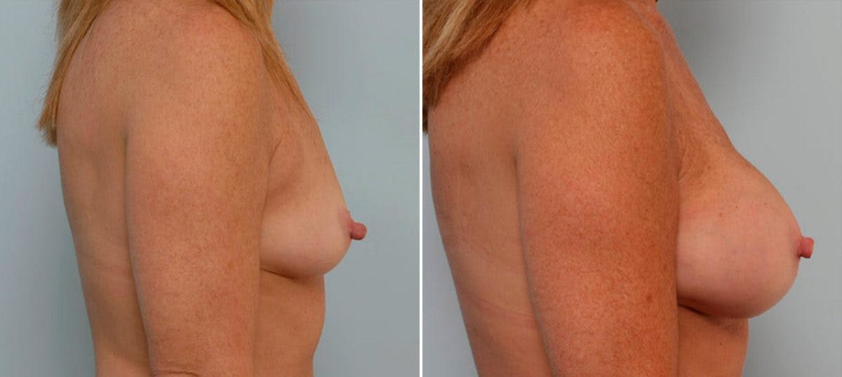 Breast Augmentation Before & After Gallery - Patient 54886706 - Image 3
