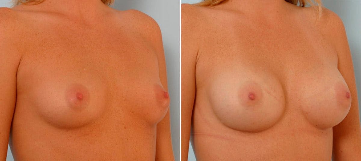 Breast Augmentation Before & After Gallery - Patient 54886709 - Image 2