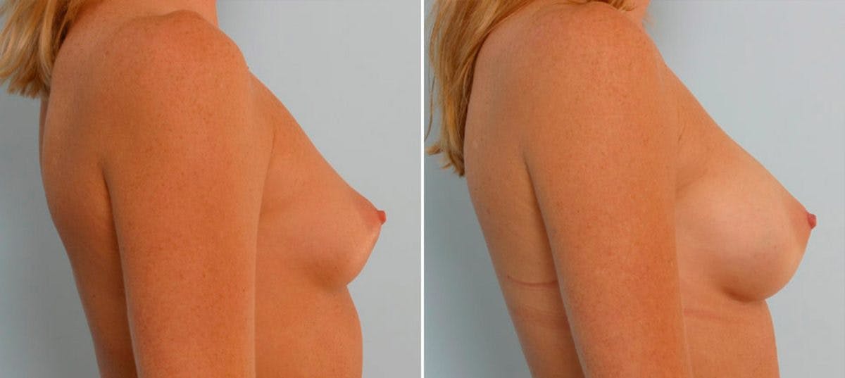 Breast Augmentation Before & After Gallery - Patient 54886709 - Image 3