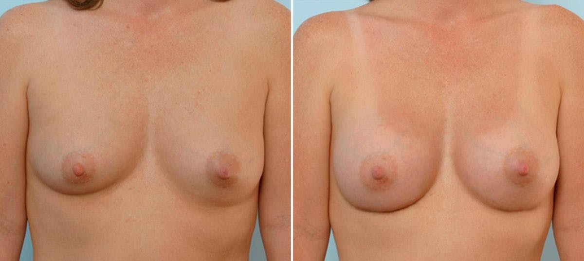Breast Augmentation Before & After Gallery - Patient 54886714 - Image 1