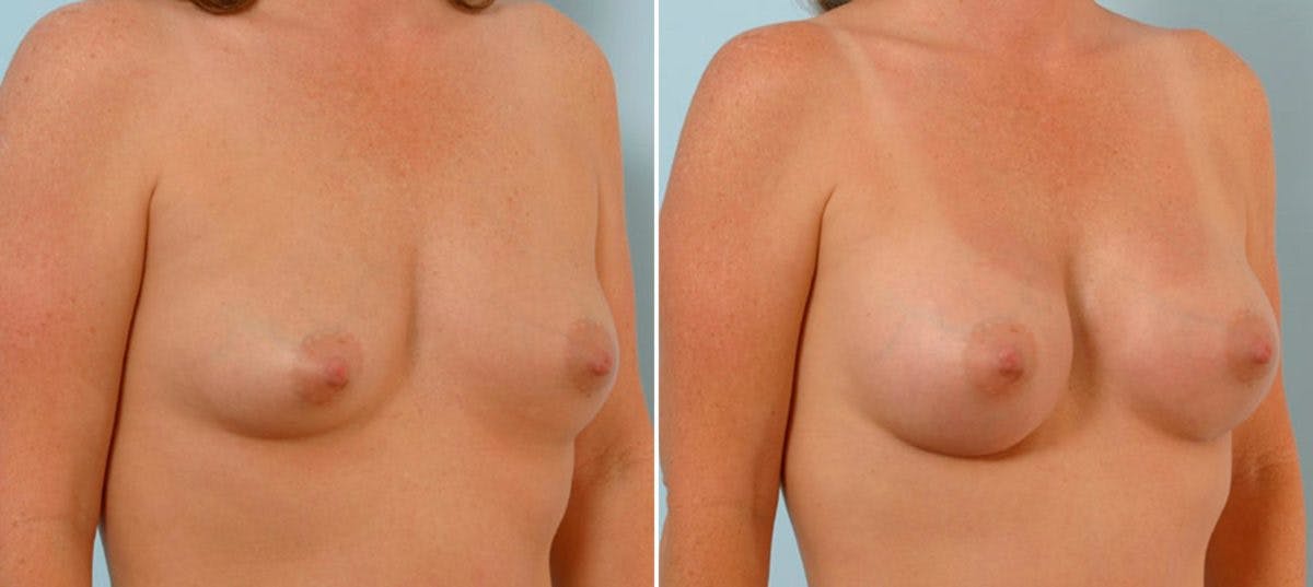 Breast Augmentation Before & After Gallery - Patient 54886714 - Image 2