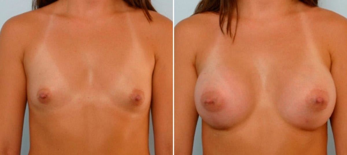 Breast Augmentation Before & After Gallery - Patient 54886723 - Image 1