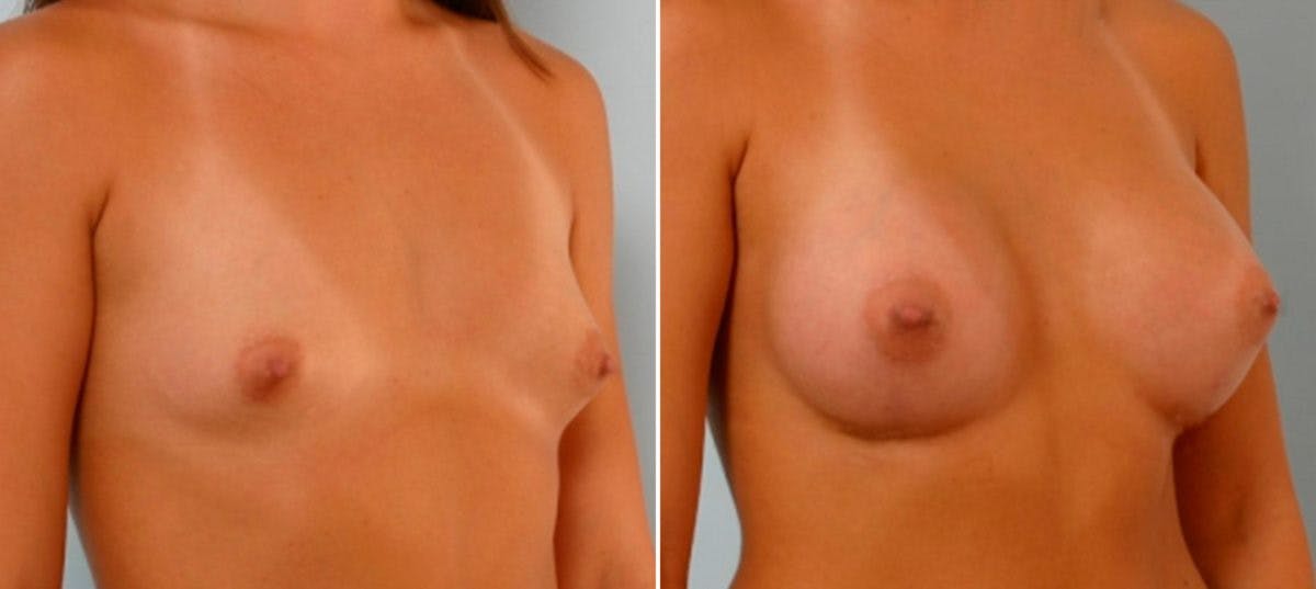 Breast Augmentation Before & After Gallery - Patient 54886723 - Image 2