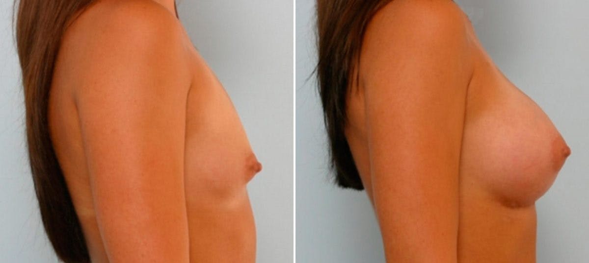 Breast Augmentation Before & After Gallery - Patient 54886723 - Image 3