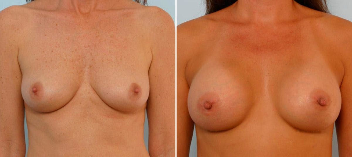 Breast Augmentation Before & After Gallery - Patient 54886728 - Image 1