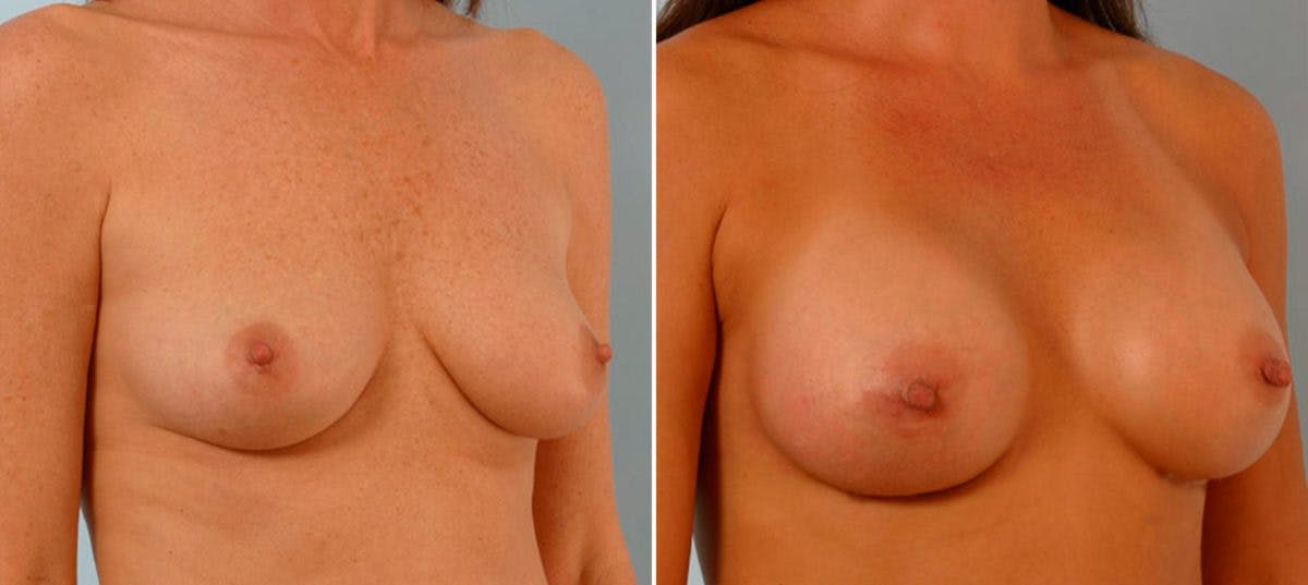Breast Augmentation Before & After Gallery - Patient 54886728 - Image 2