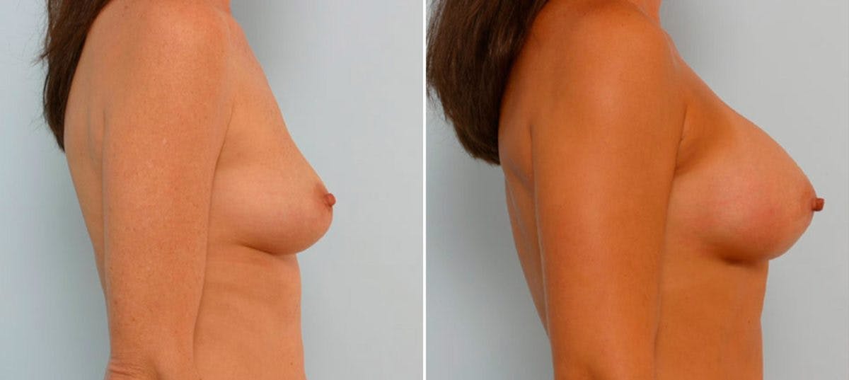 Breast Augmentation Before & After Photo - Patient 54886728 - Image 3