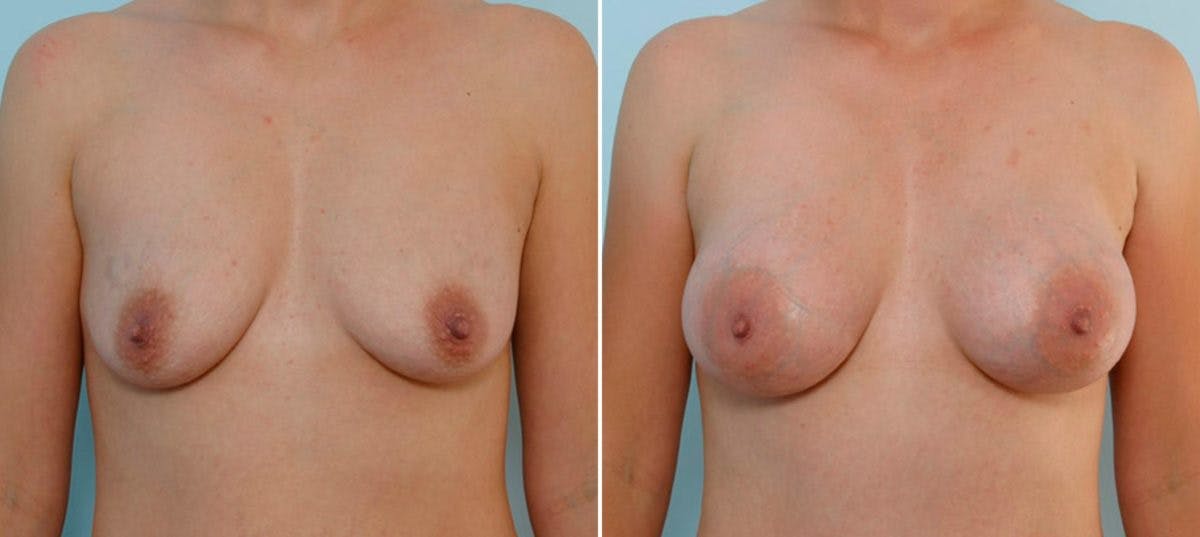 Breast Augmentation Before & After Gallery - Patient 54886733 - Image 1