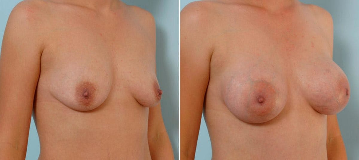 Breast Augmentation Before & After Gallery - Patient 54886733 - Image 2