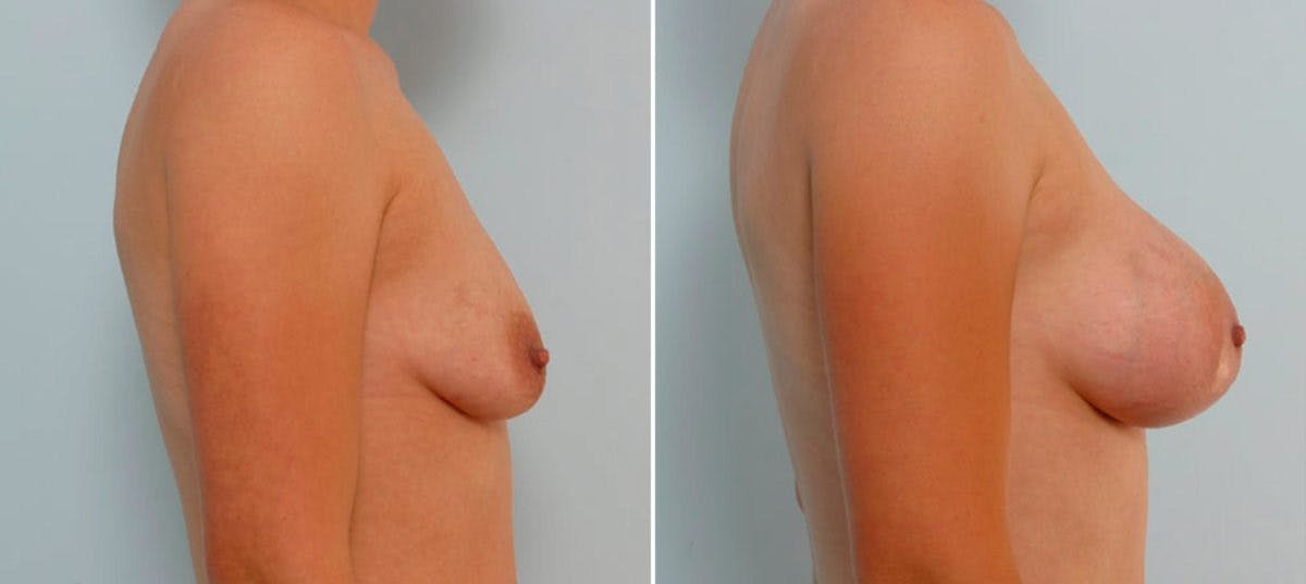 Breast Augmentation Before & After Gallery - Patient 54886733 - Image 3