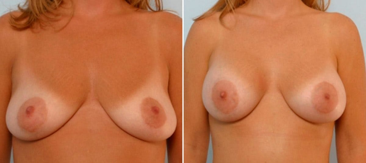 Breast Augmentation Before & After Gallery - Patient 54886735 - Image 1