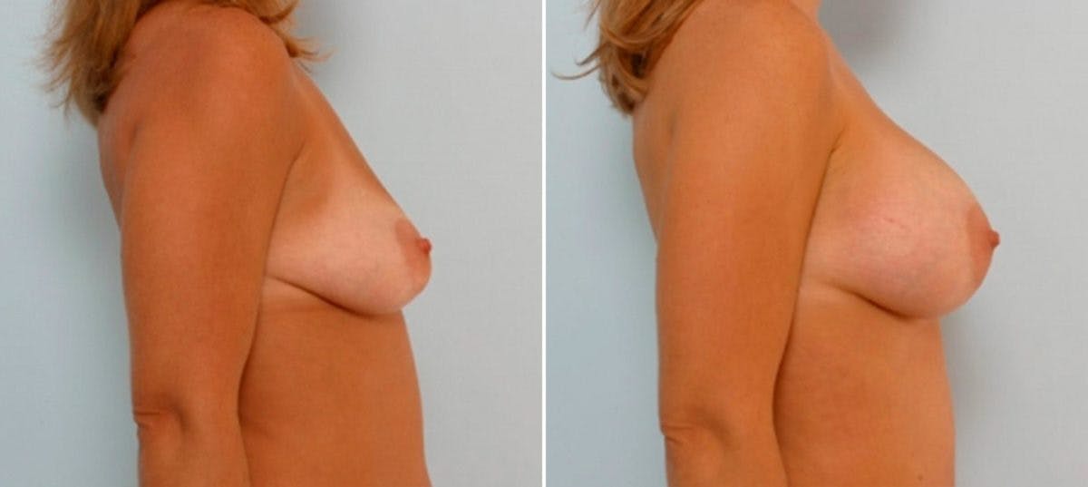 Breast Augmentation Before & After Gallery - Patient 54886735 - Image 2