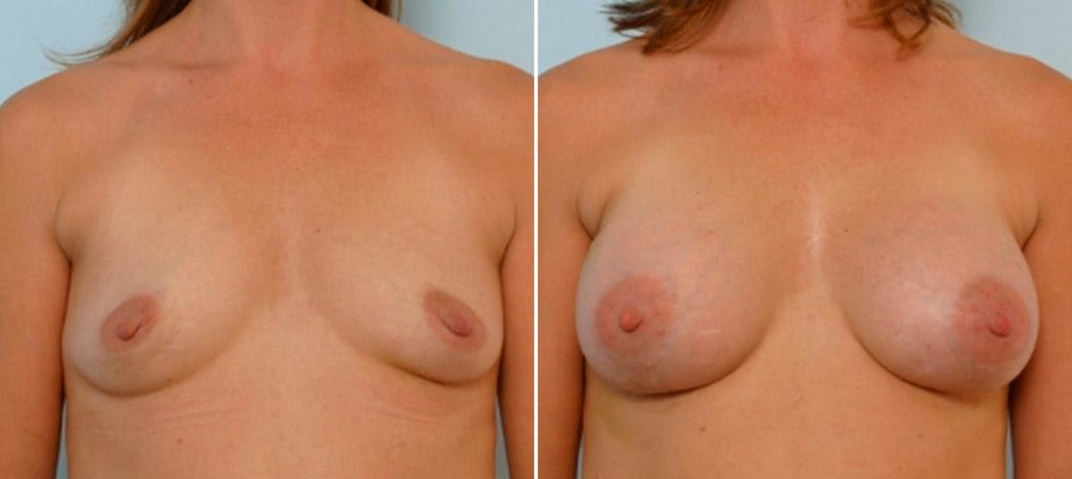 Breast Augmentation Before & After Gallery - Patient 54886738 - Image 1