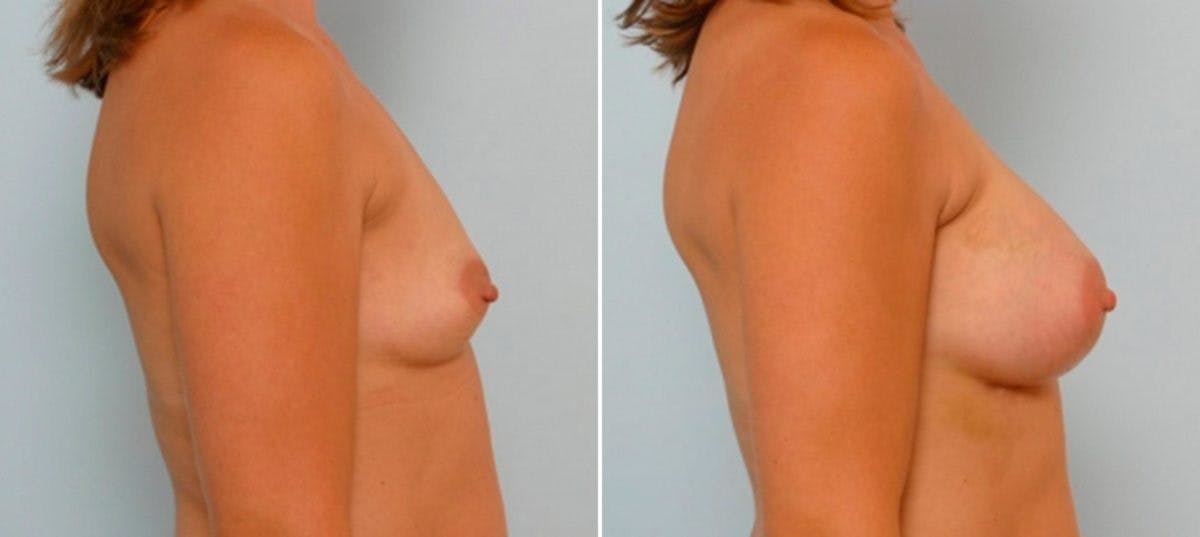 Breast Augmentation Before & After Gallery - Patient 54886738 - Image 3