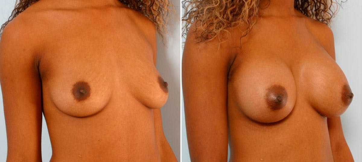 Breast Augmentation Before & After Photo - Patient 54886744 - Image 2