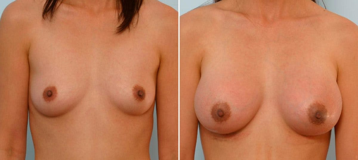 Breast Augmentation Before & After Gallery - Patient 54886747 - Image 1