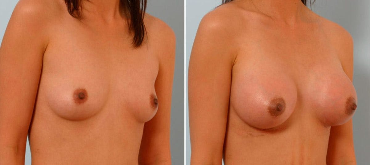 Breast Augmentation Before & After Gallery - Patient 54886747 - Image 2