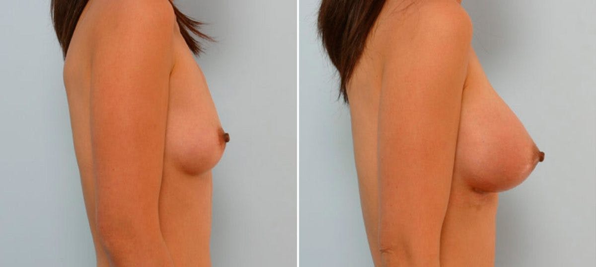Breast Augmentation Before & After Gallery - Patient 54886747 - Image 3