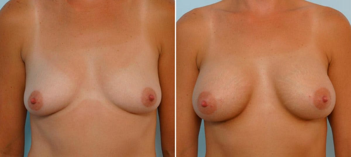 Breast Augmentation Before & After Gallery - Patient 54886750 - Image 1
