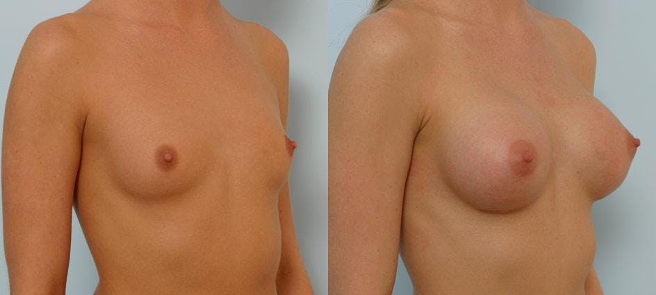 Breast Augmentation Before & After Gallery - Patient 54886752 - Image 2