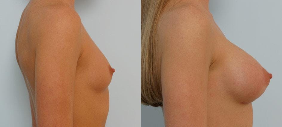 Breast Augmentation Before & After Gallery - Patient 54886752 - Image 3