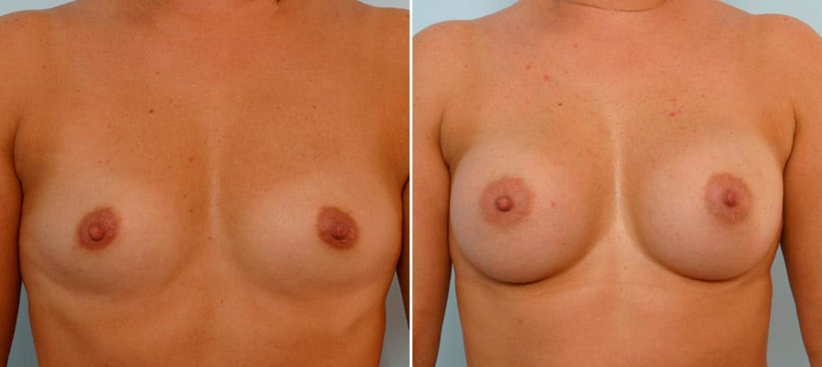 Breast Augmentation Before & After Gallery - Patient 54886753 - Image 1