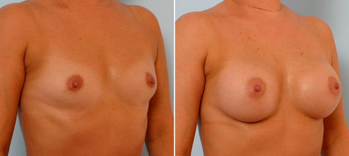 Breast Augmentation Before & After Gallery - Patient 54886753 - Image 2