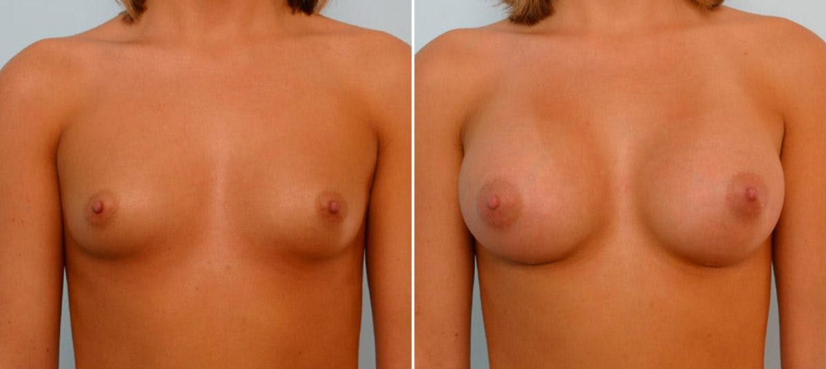 Breast Augmentation Before & After Gallery - Patient 54886754 - Image 1