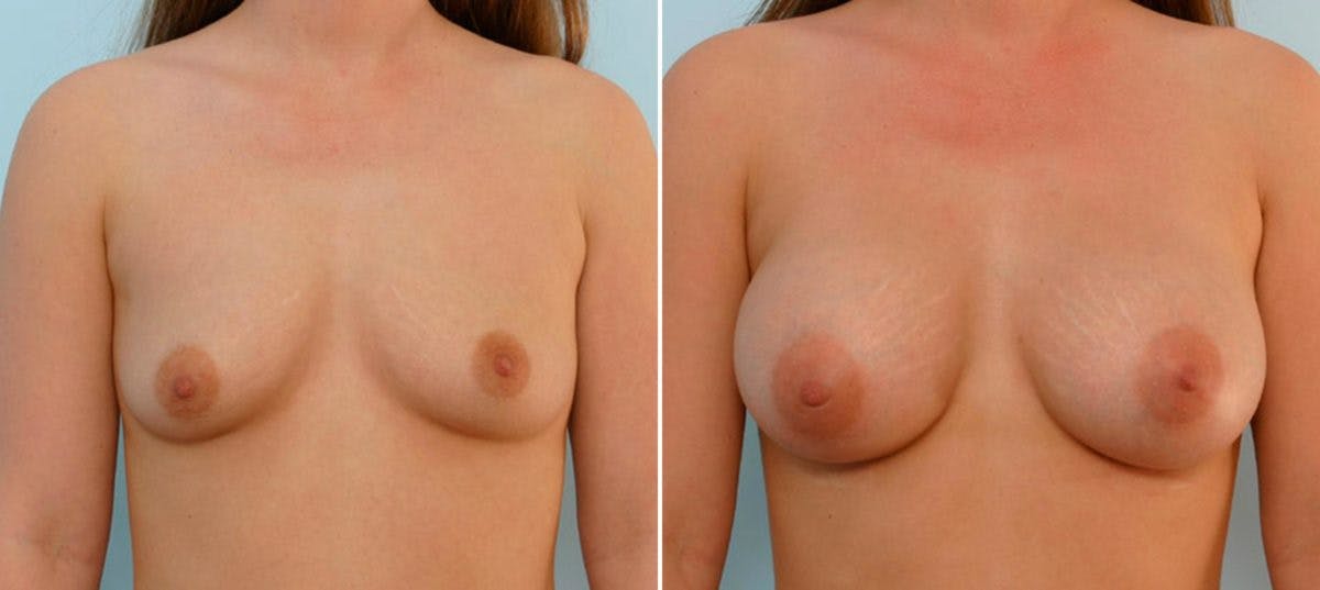 Breast Augmentation Before & After Gallery - Patient 54886755 - Image 1