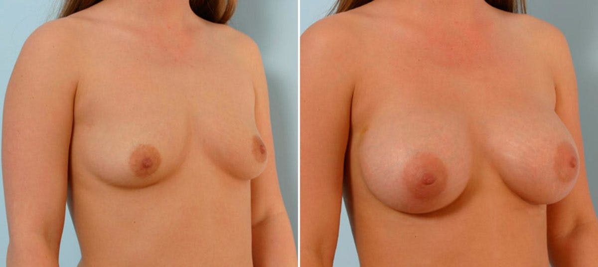 Breast Augmentation Before & After Photo - Patient 54886755 - Image 2