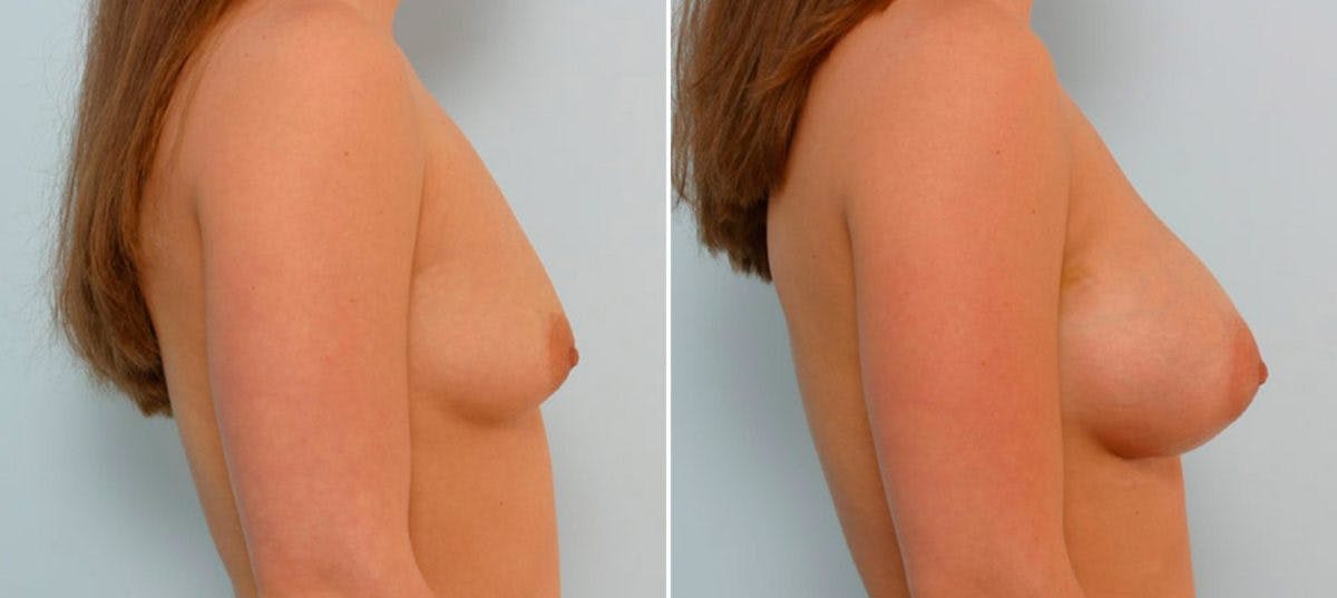 Breast Augmentation Before & After Gallery - Patient 54886755 - Image 3