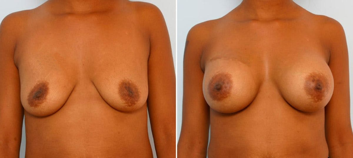 Breast Augmentation Before & After Gallery - Patient 54886761 - Image 1