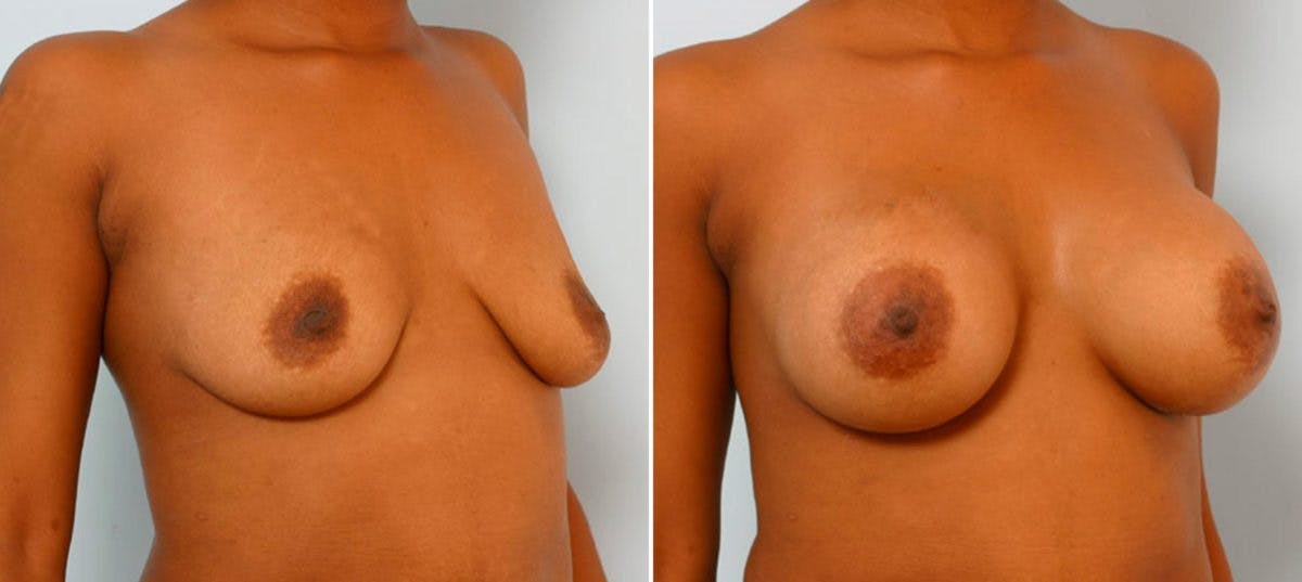 Breast Augmentation Before & After Gallery - Patient 54886761 - Image 2