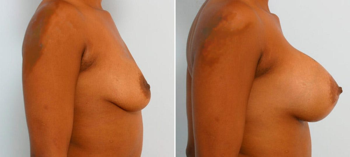 Breast Augmentation Before & After Gallery - Patient 54886761 - Image 3