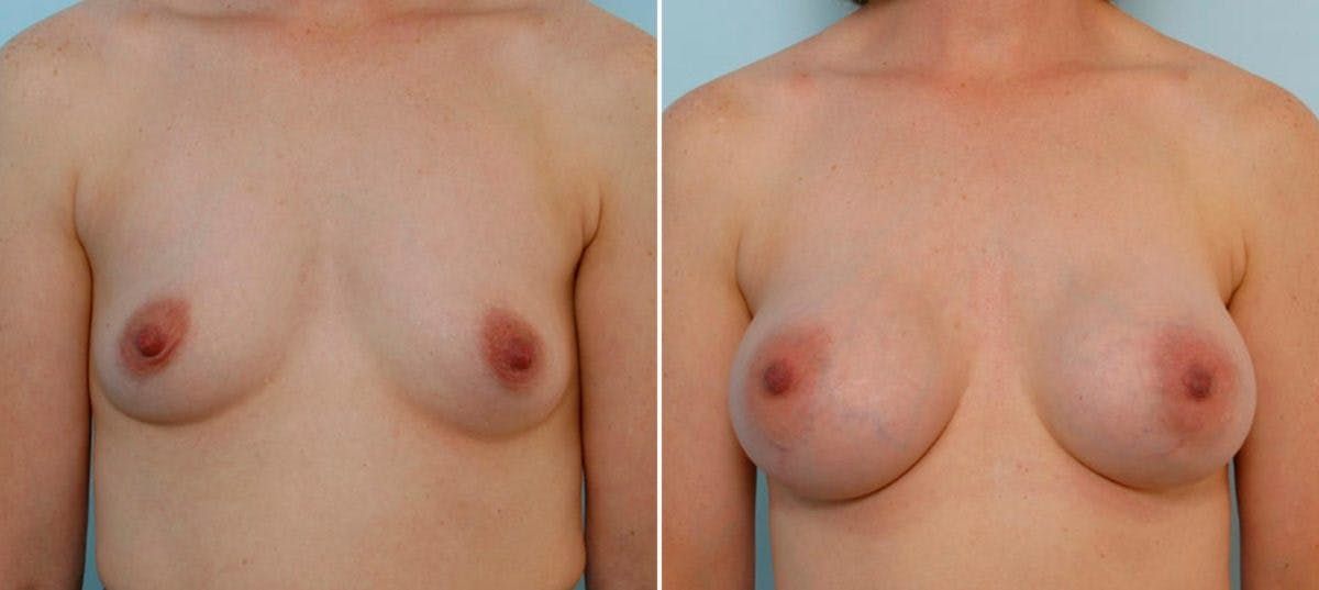 Breast Augmentation Before & After Gallery - Patient 54886766 - Image 1