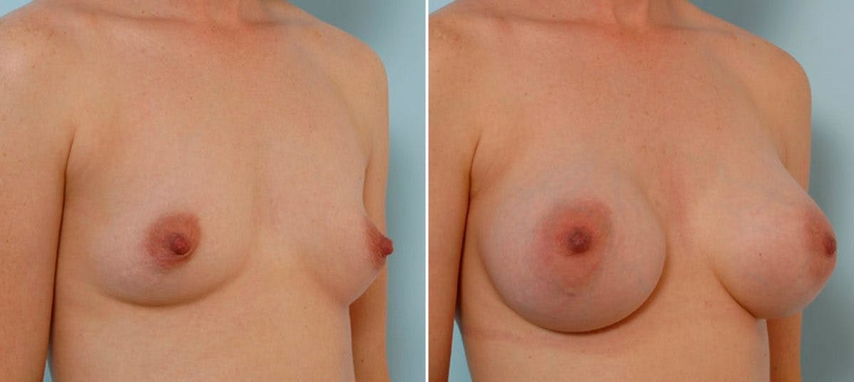 Breast Augmentation Before & After Gallery - Patient 54886766 - Image 2